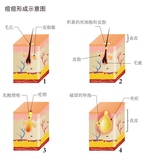 脸部痘痘形成示意图