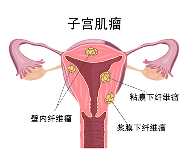 子宫肌瘤 疾病